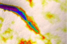Marionette line, 3D skin analysis before use