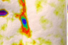 Marionette line, 3D skin analysis after one use