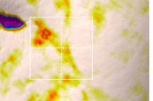 Marionette line, 3D skin analysis after two weeks